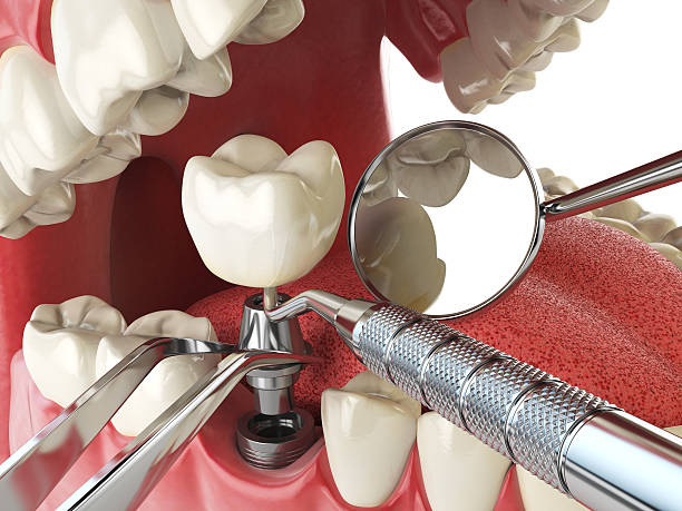 Best Emergency Root Canal Treatment in Sam Rayburn, TX